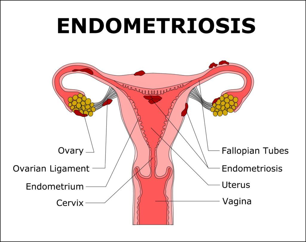 endometriosis diagram 