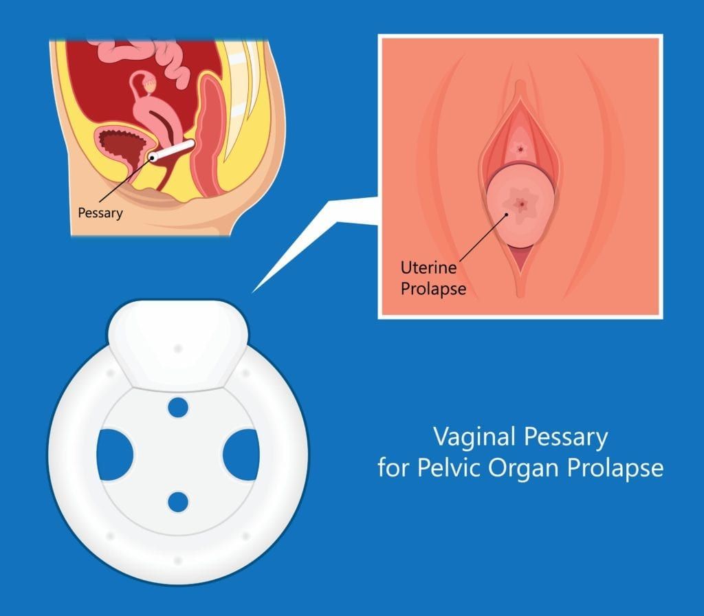 vaginal pessary for pelvic organ prolapse