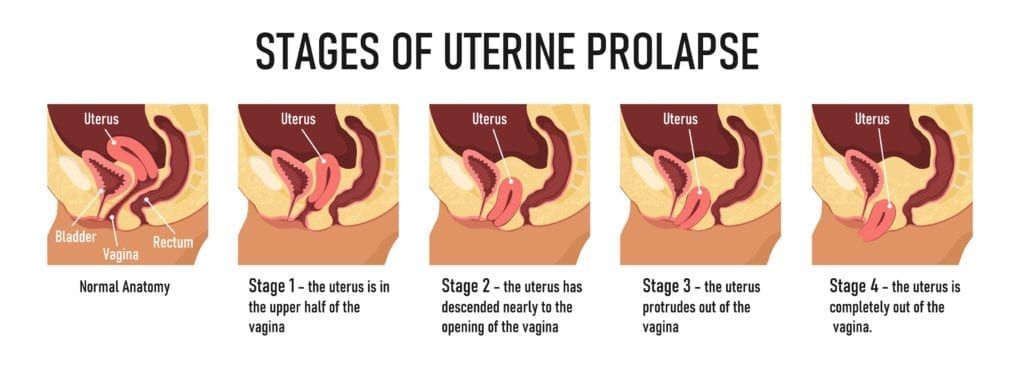 stages of uterine prolapse