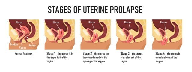 uterine-prolapse-do-you-need-surgery-sunshine-state-women-s-care-llc