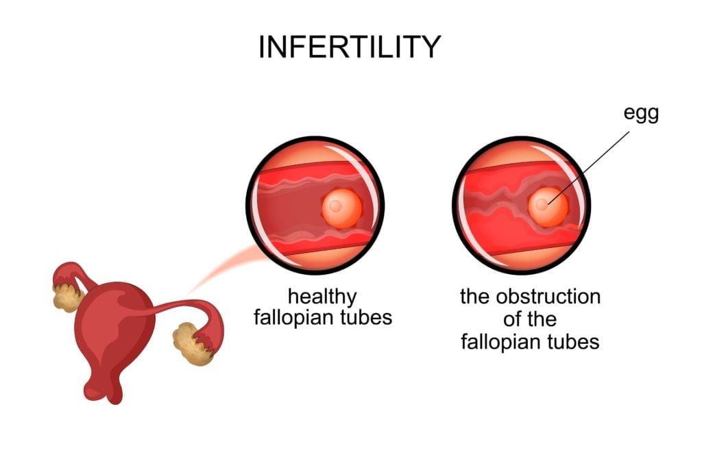 tubal factor infertility