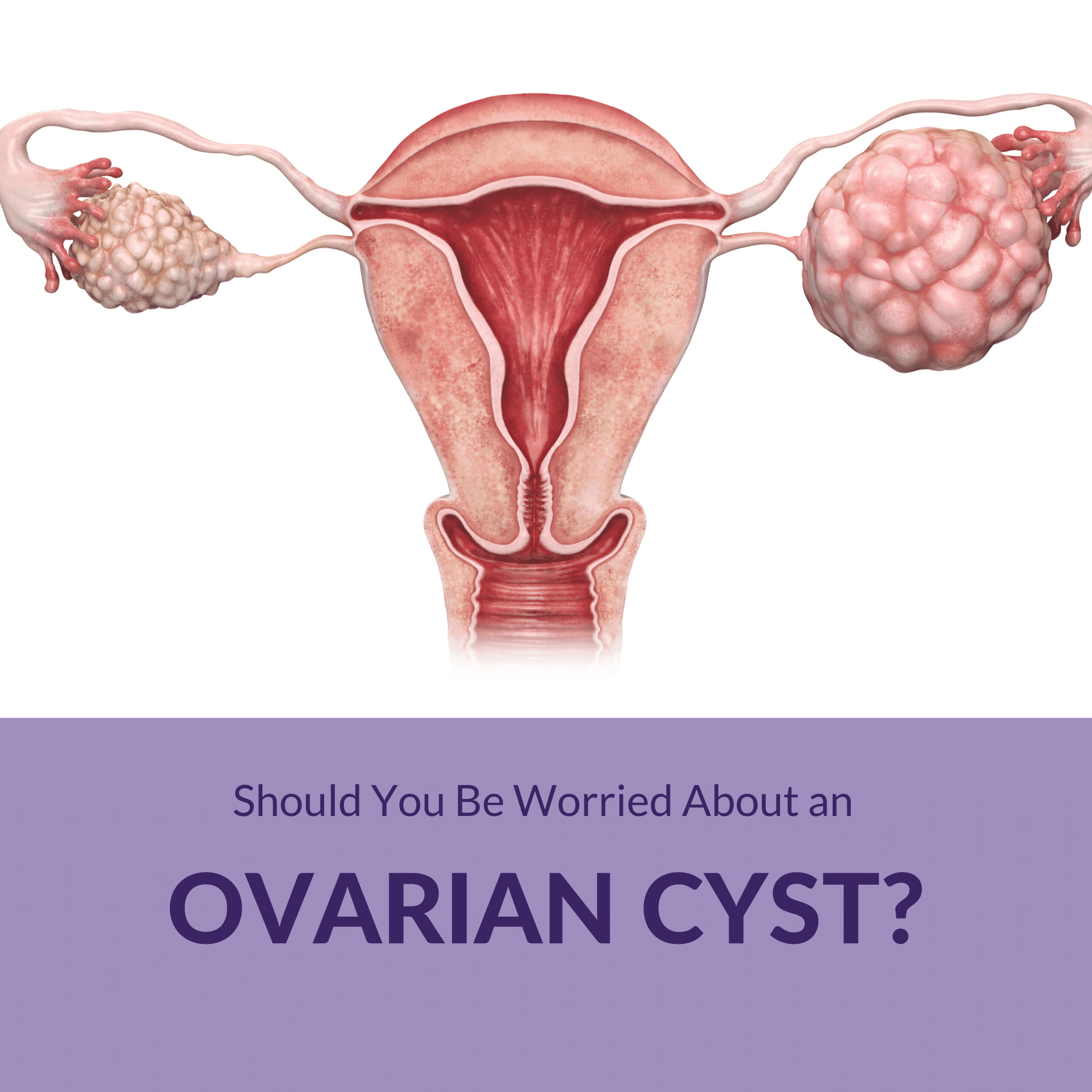 Should You Be Worried About an Ovarian Cyst? - Sunshine State