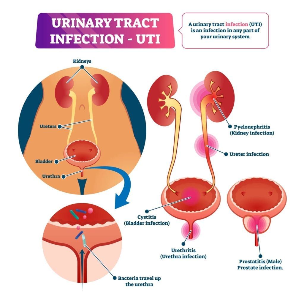 diagram of urinary tract infection