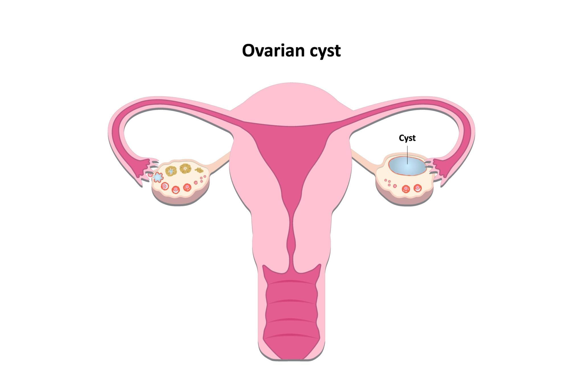 Should You Be Worried About An Ovarian Cyst Sunshine State Womens Care Llc 