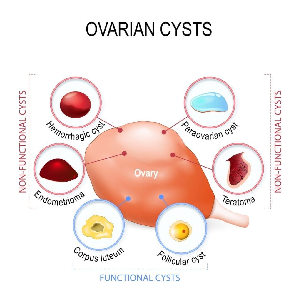 Simple cyst deals ovary size