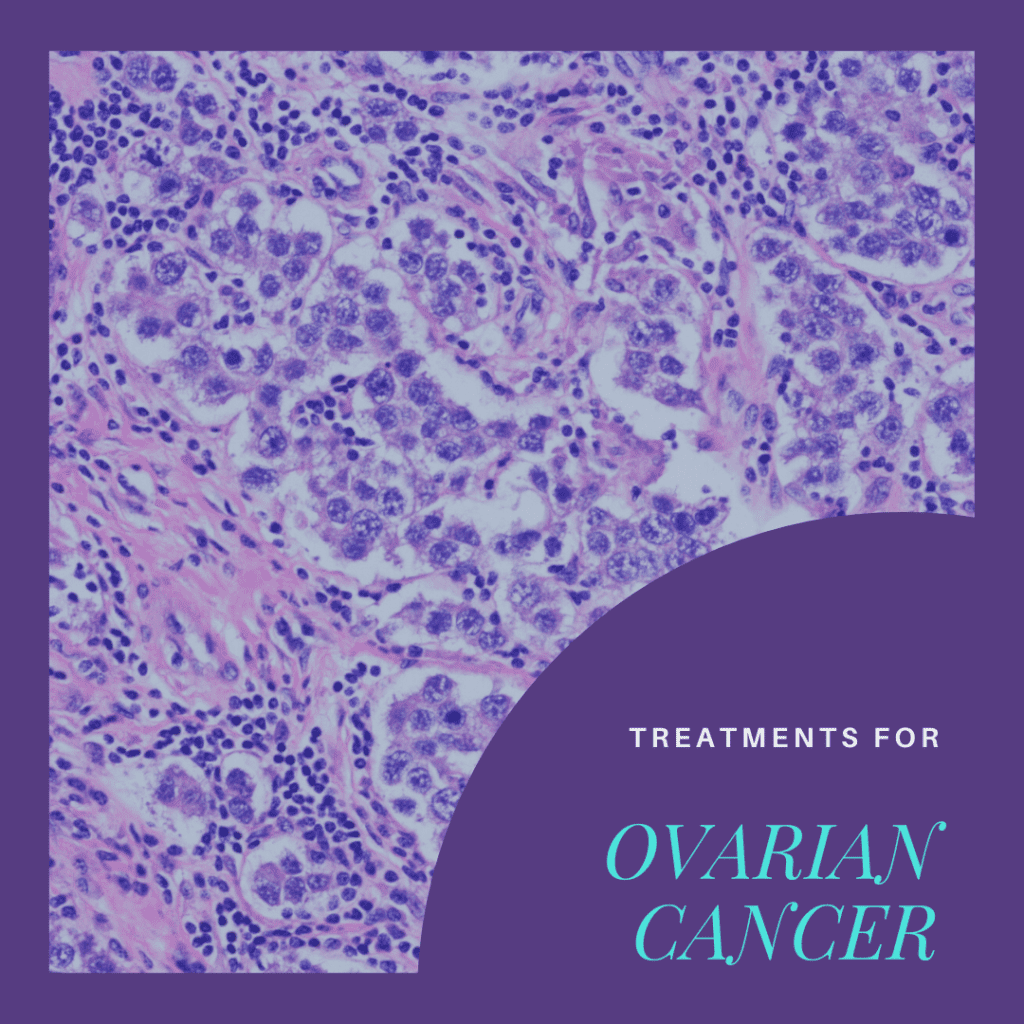 Treatments For Ovarian Cancer
