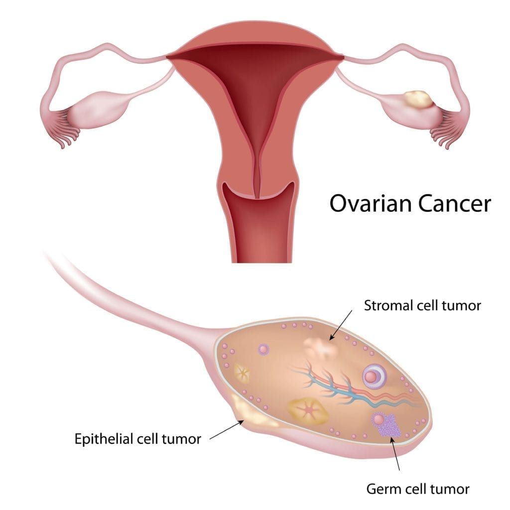 types of ovarian cancer