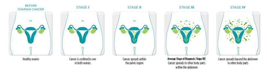 stages of ovarian cancer
