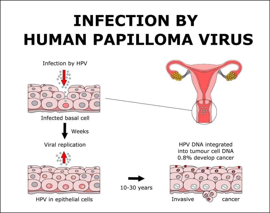 diagram showing how HPV turns to cancer