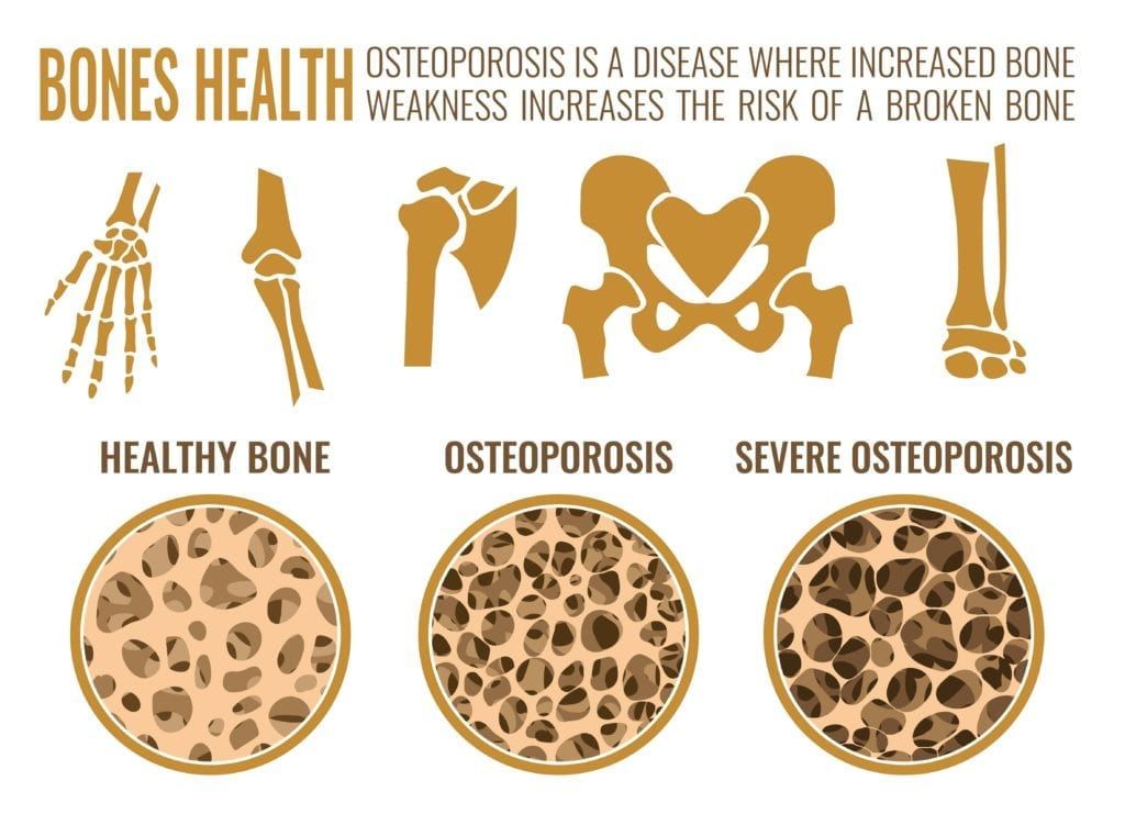 diagram showing the progression of osteoporosis