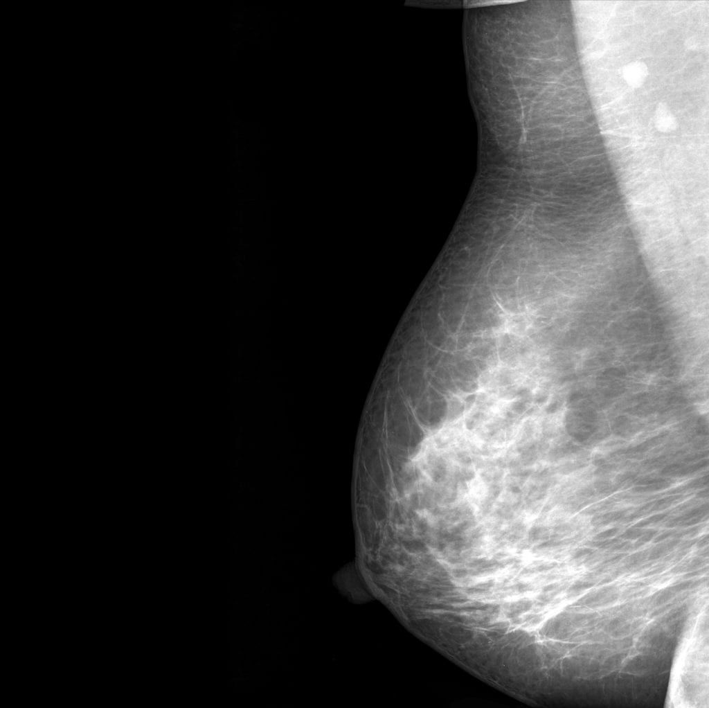mammogram scan of breast