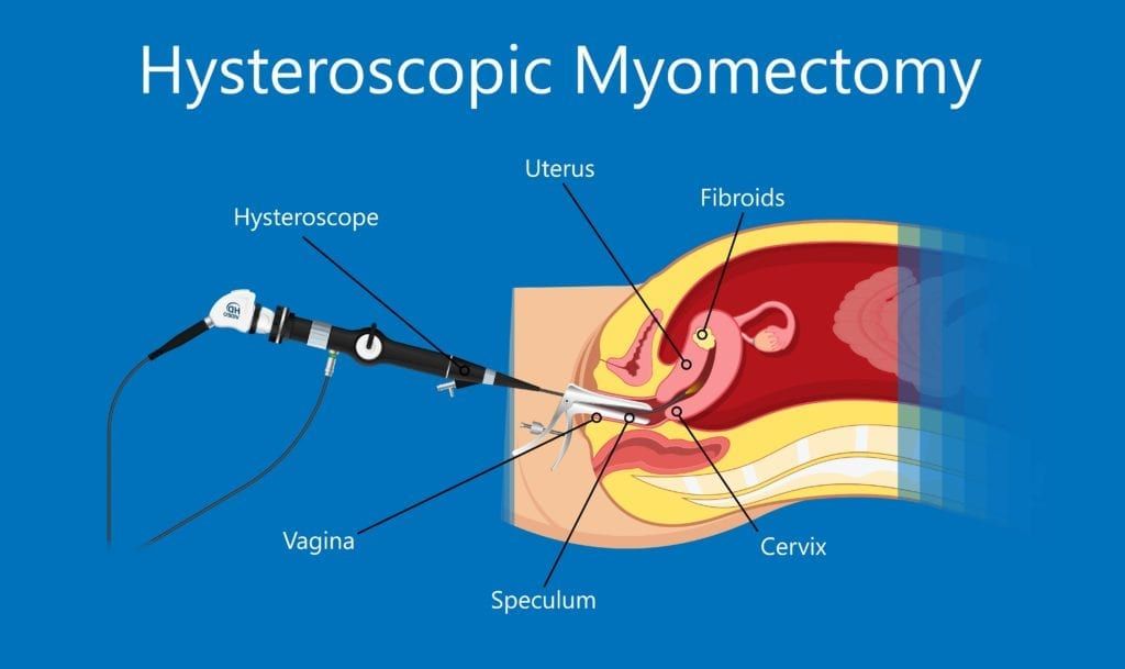 hysteroscopic myomectomy