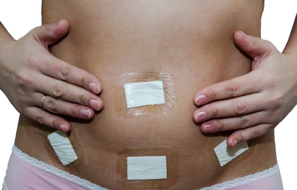 woman with multiple laparoscopic incisions on her abdomen
