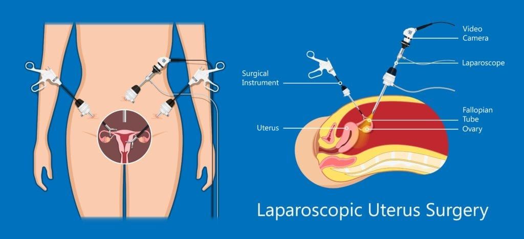 laparoscopic uterus surgery